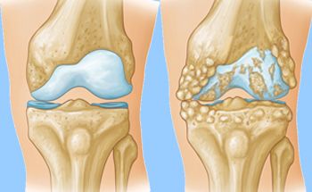 osteoartrite no joelho